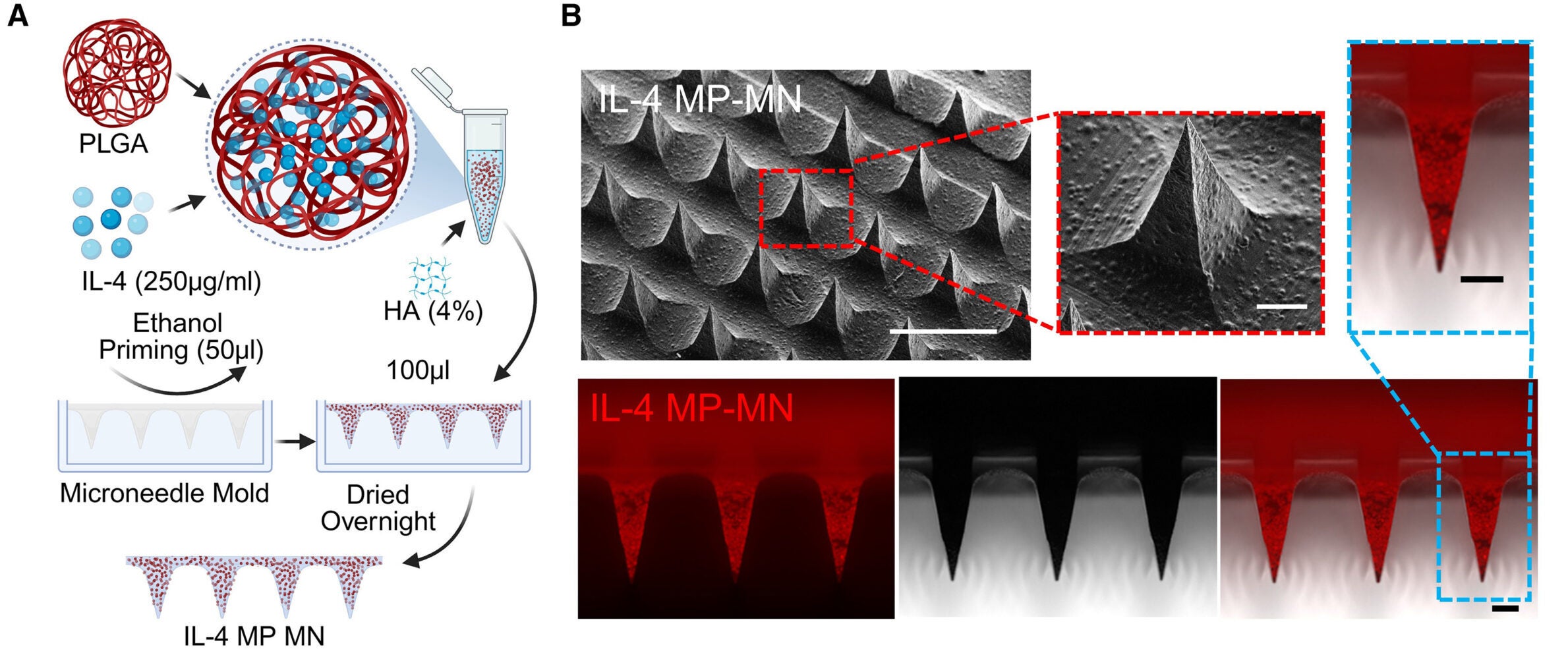 IL-4 microparticle-loaded microneedle patch promotes M2-like macrophage polarization and stimulates cardiac cell proliferation