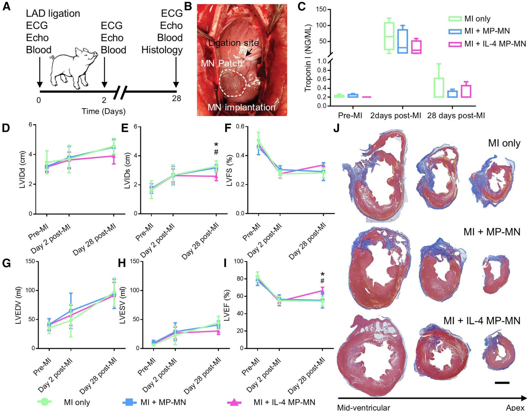 The pig MI model demonstrated the efficacy of IL-4 MP-MN with improved cardiac function and cardiomyocyte proliferation