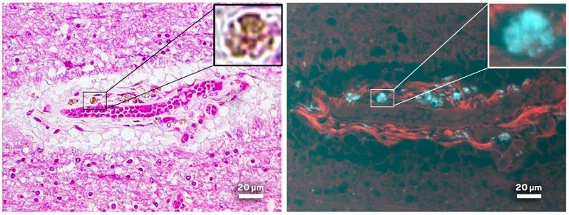 Under a bright-field microscope, you can see brown deposits in a brain sample from a person with early-onset Alzheimer’s disease (left). When the sample is viewed under ultraviolet fluorescence microscopy (right), those deposits appear blue, allowing Bearer to identify them as microplastics.