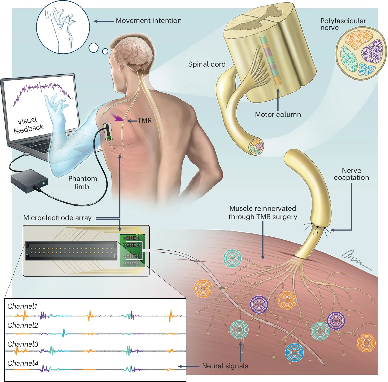 Biointerface based on TMR of a polyfascicular nerve and the use of a microelectrode array for recording and decoding.