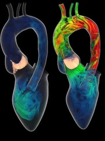 Ventricle-valve-aorta flow analysis, with the ventricle shrinking and expanding and the valve opening and closing. Flow patterns at two instants during the cardiac cycle, when the valve is closed (left) and open (right).