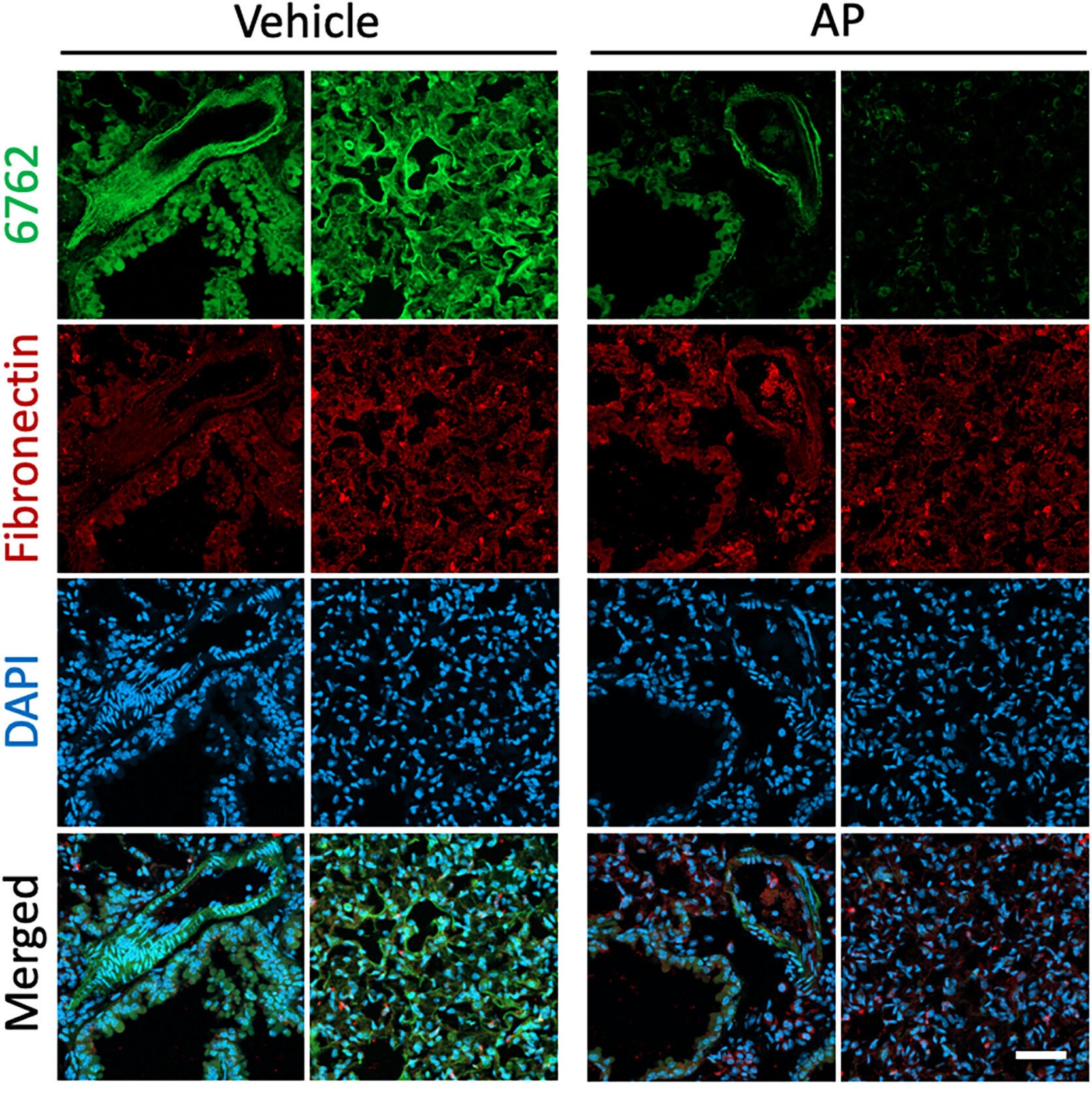 Removal of p16-positive cells leads to reduced aptamer 6762 (but not fibronectin) staining. Aptamer 6762 is detected by fluorescein label (green). Fibronectin antibody is detected with AlexaFluor594 anti-rabbit secondary (red). Nuclei are stained with DAPI (blue).