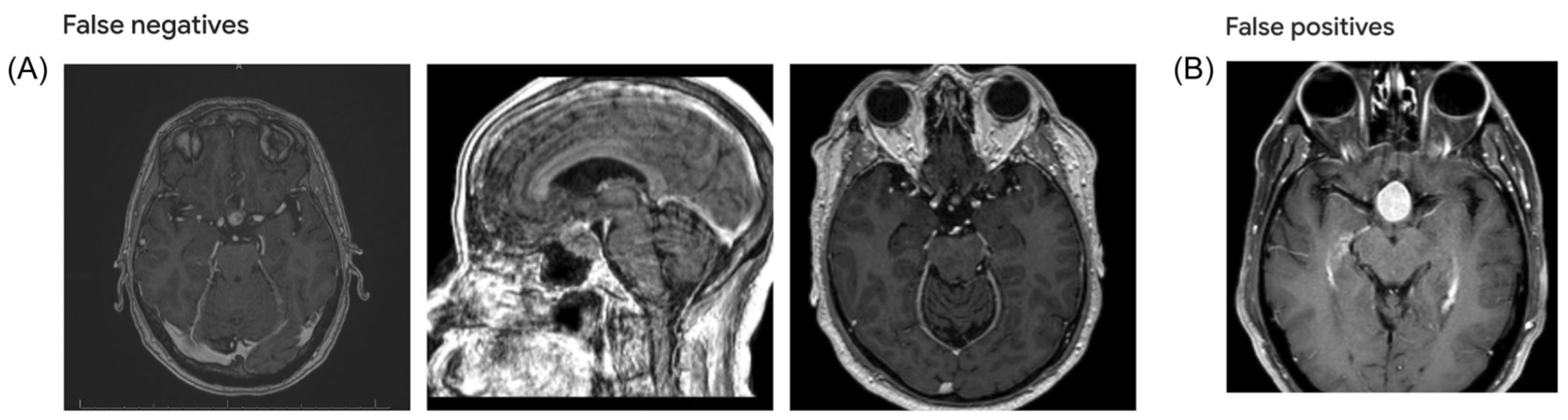 Representative false positive and false negative magnetic resonance imaging (MRI) images misclassified by the AutoML model. (Panel A) FN instances in which the model incorrectly predicted the MRI scan as a parasellar meningiomas (PSM) instead of a pituitary macroadenomas (PA). (Panel B) FP instance in which the model incorrectly predicted the MRI scan as a PA instead of a PSM.