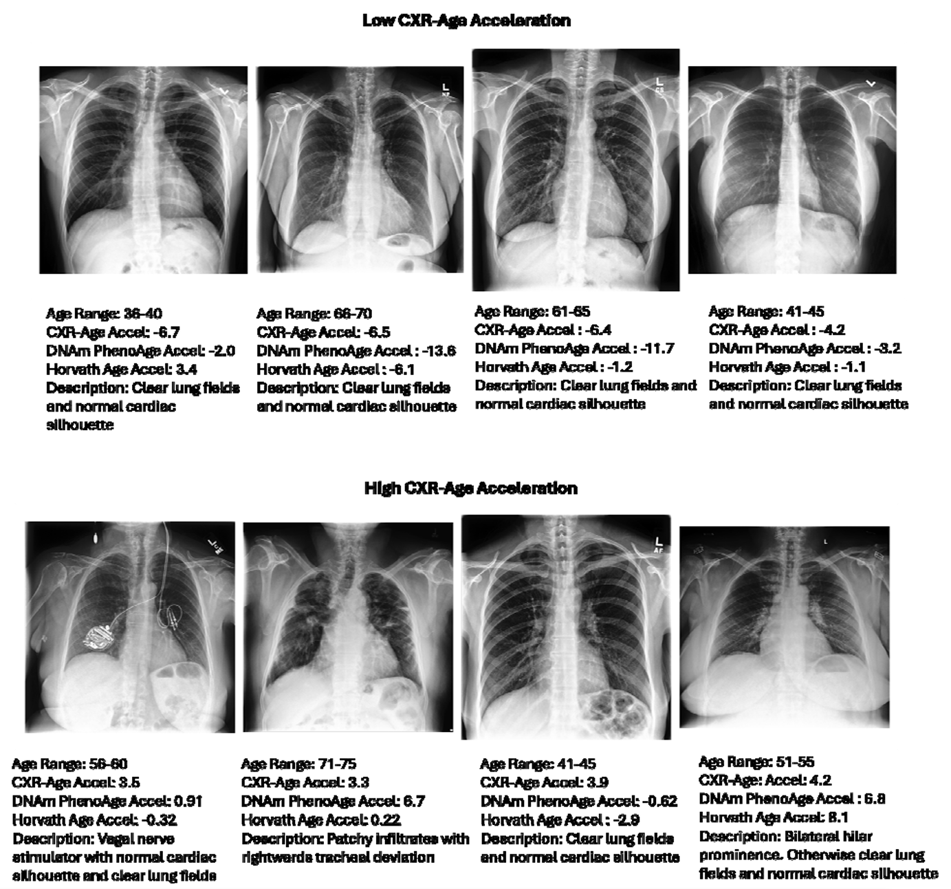 Representative Chest-X-rays with the Lowest CXR-Age Acceleration. CXRs with low age acceleration tended to have clear lung fields and normal cardiac silhouettes, while CXRs s with high age acceleration tended to have lung field and airway findings such as patchy infiltrates, hilar enlargement, peribronchial cuffing, and deviated trachea.