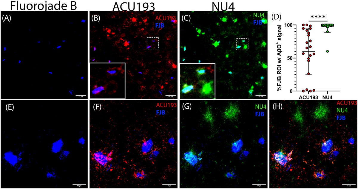 ACU193+ puncta predominate in early-stage degenerating neurons; dense NU4 signal predominates in late-stage degenerating neurons.