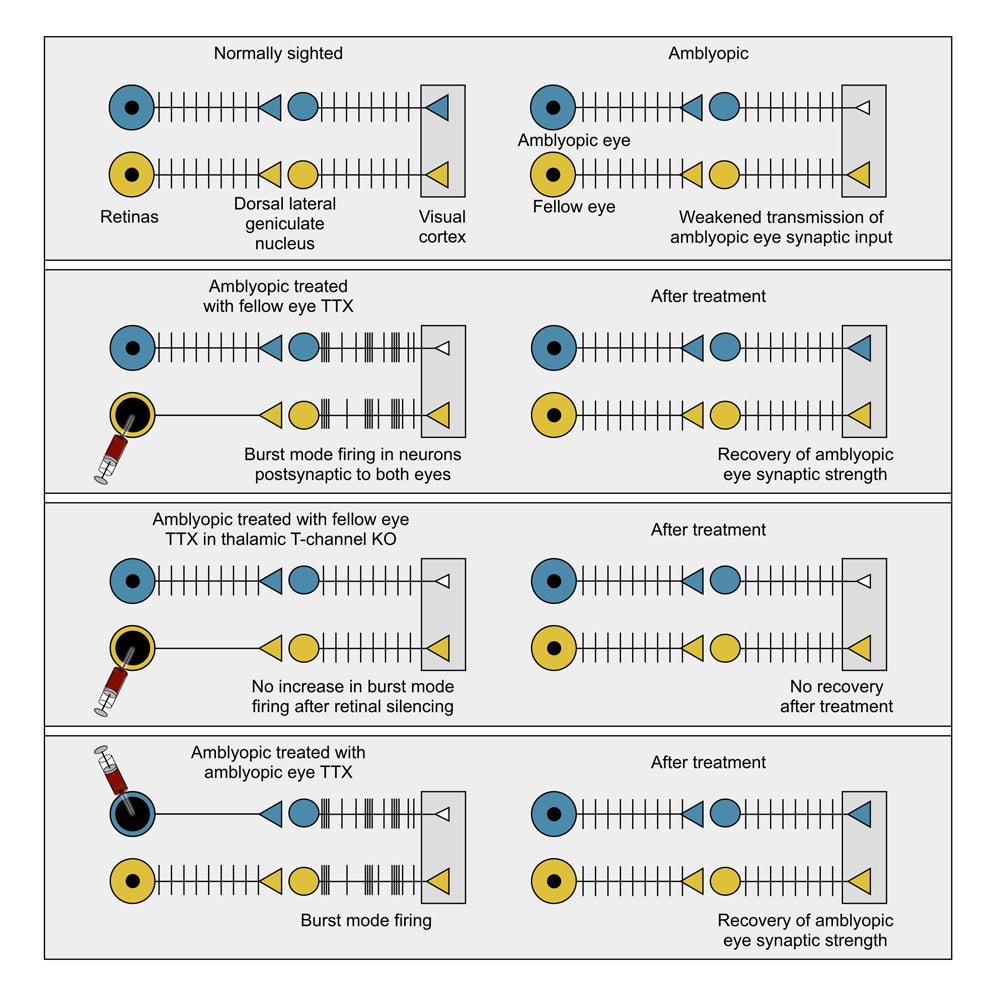 Graphical abstract: Recovery from amblyopia enabled by monocular inactivation requires dLGN bursting