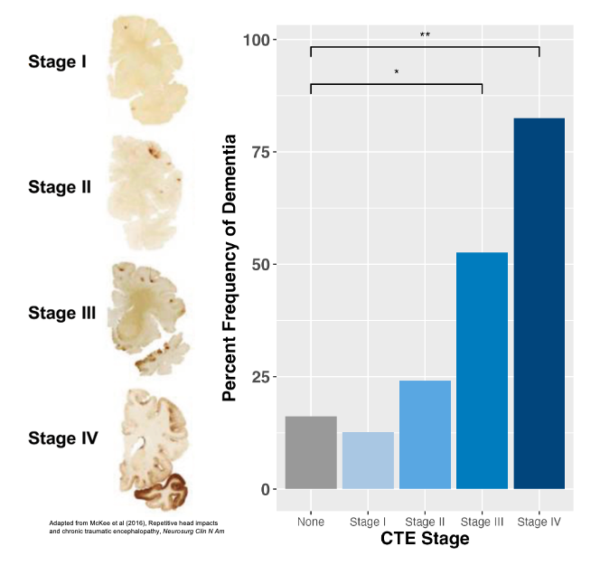 Figure shows that rates of dementia increase as severity of CTE neuropathology increases. Advanced CTE neuropathology is associated with 4.48X increased odds for having dementia during life. Compared to those without CTE, low stage CTE neuropathology is not associated with dementia.