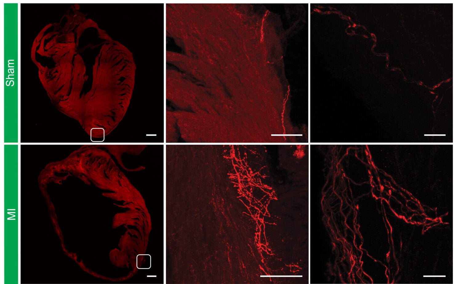 TRPV1 VSN fiber distribution in sham and MI mice hearts (left). Magnified images (20×, middle). High-magnification images (100×) showing TRPV1-free nerve endings (right).