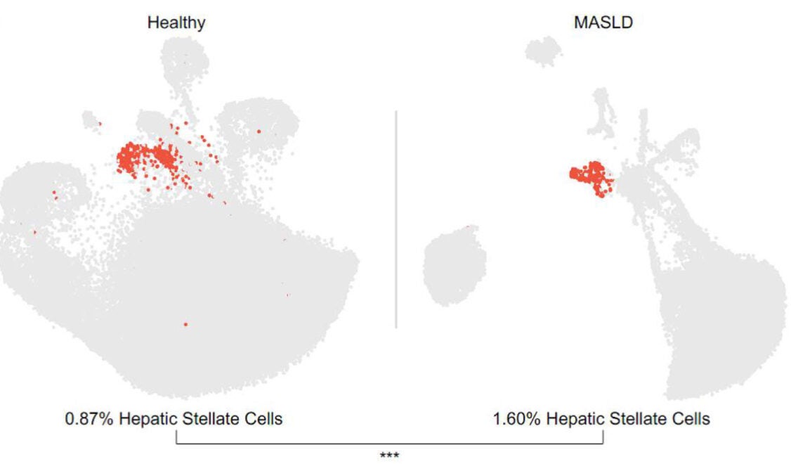 EVT0185 inhibits DNL and TGFβ1-induced activation of primary human-derived HSCs