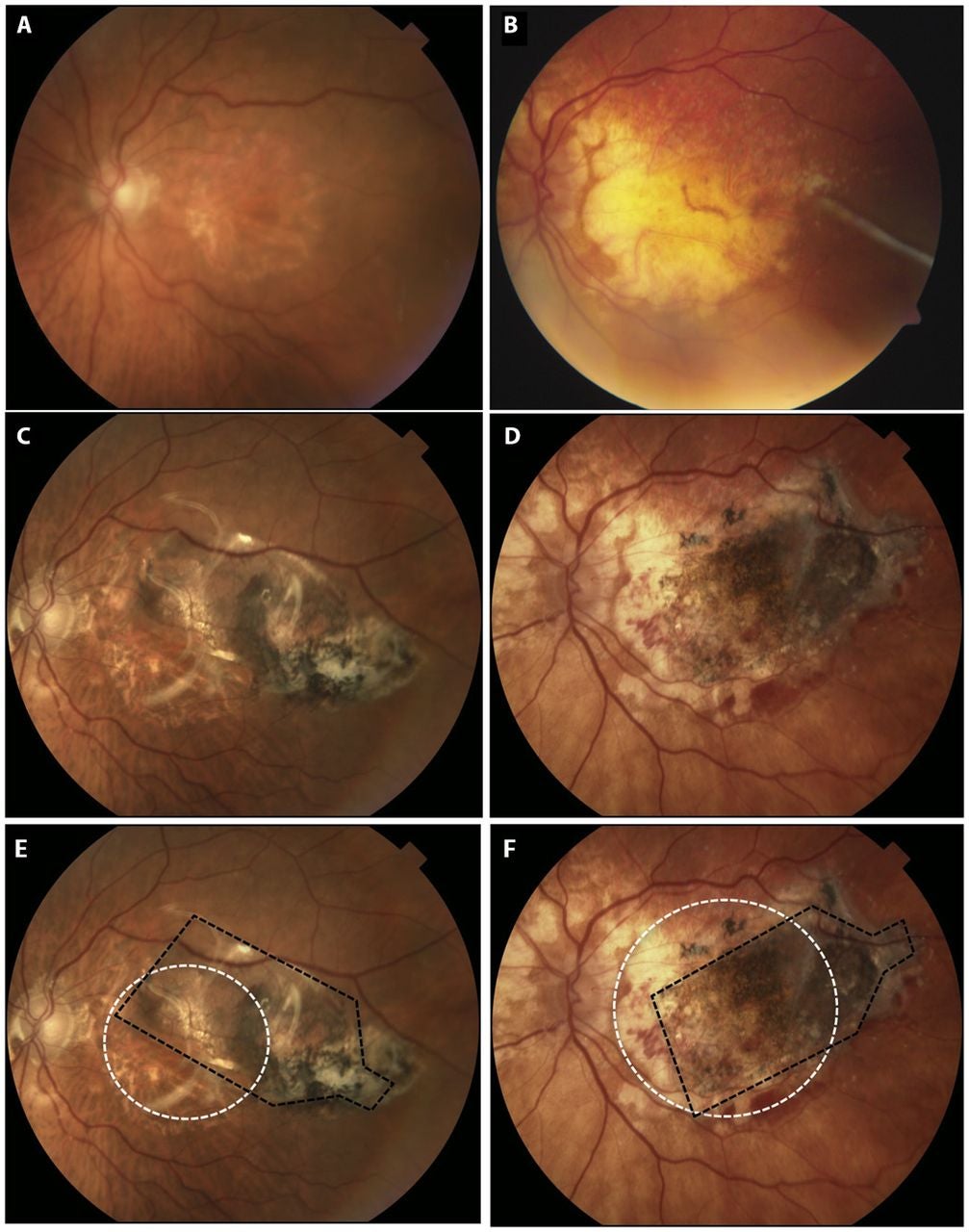 Preoperative and postoperative color fundus photographs of the retina in two representative study subjects.