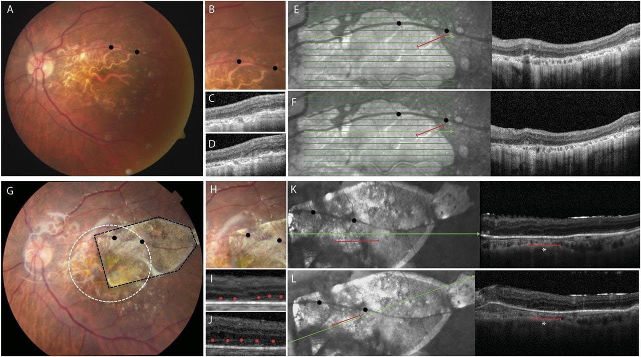 Preoperative and postoperative fundus photographs and OCT images of CPCB-RPE1 in subject 128.