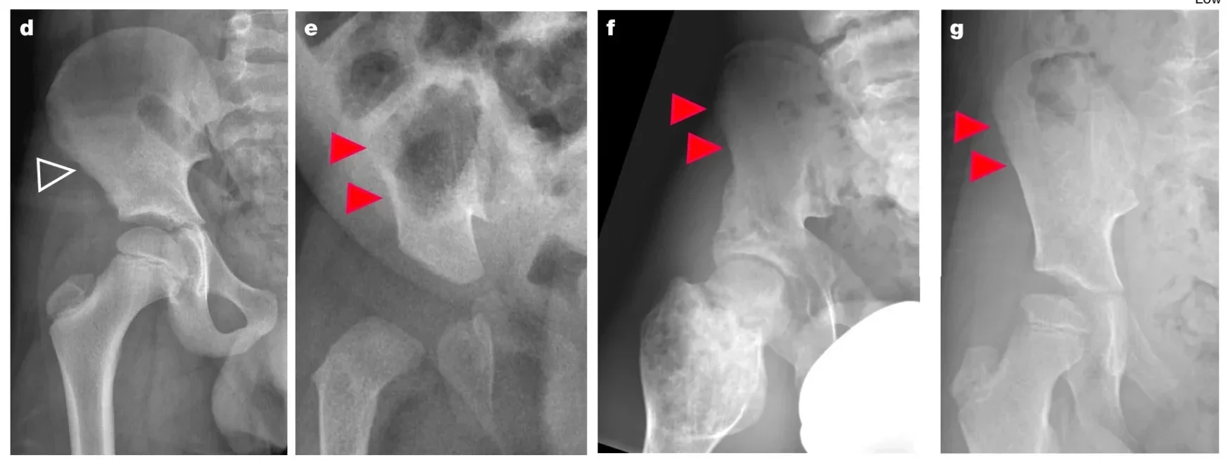 Radiographs of right hemipelves in a healthy 10-year-old boy (d), a 3-month-old girl with campomelic dysplasia (e), a 16-year-old boy with JMC (f) and a 9-year-old girl with Eiken syndrome (ES) (g).