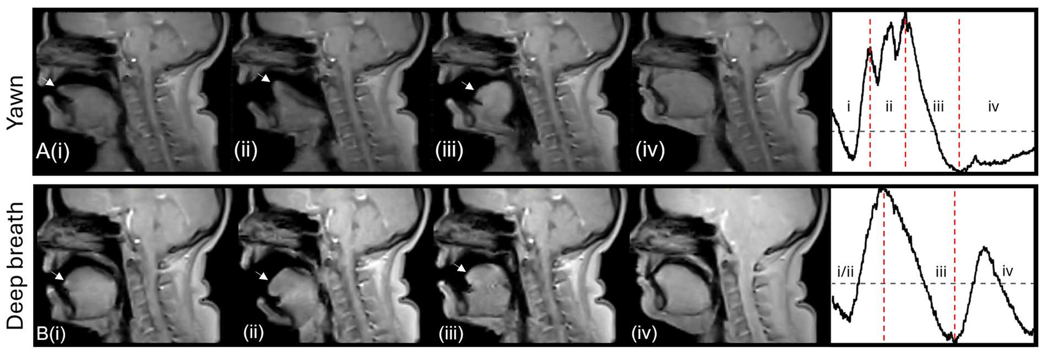 Sequential sagittal MRI frames showing tongue and oropharyngeal motion during yawning and deep breathing with a gape.