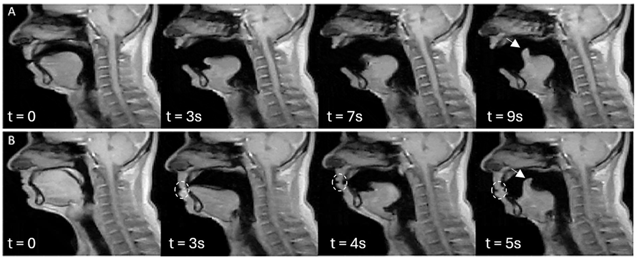 Sagittal real-time scans of a yawn and a stifled yawn in the same individual and tongue motion similarity across the cohort during yawning.