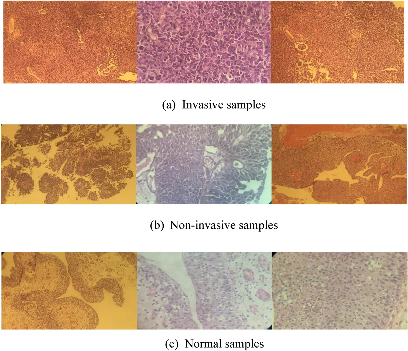 The classification of the bladder cancer based on Vision Transformers.