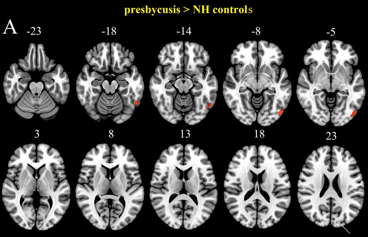 Visualization of inter-group differences in ALFF. Results were obtained by a two-tailed two-sample t-test. FDR corrected p < 0.05, cluster size > 20 voxels. L, left; R, right.
