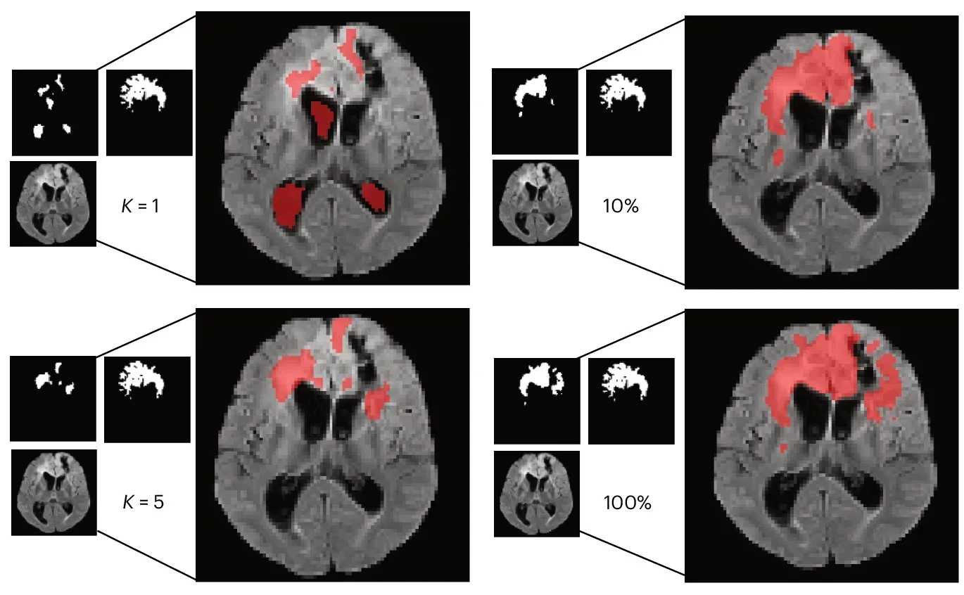 Representative axial FLAIR images with predicted tumor segmentation masks (red overlay) from BrainIAC models fine-tuned with 10%, 100%, K = 1 and K = 5 of the training data