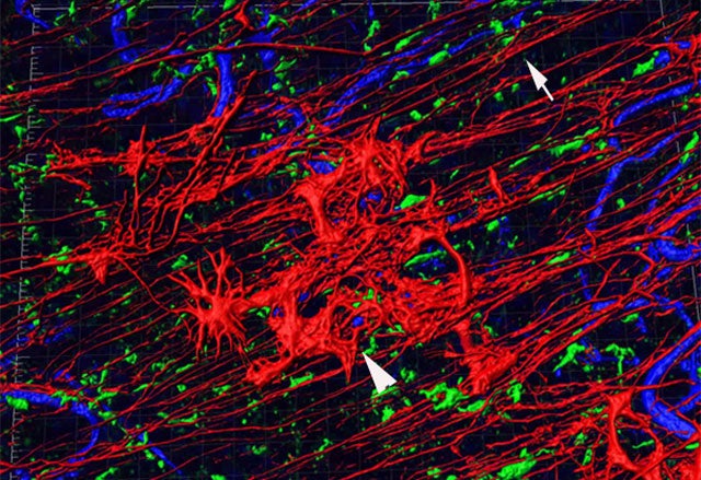 3D rendered image of a human retina shows glial cells in their normal position (arrow) and on the retinal surface, creating a bloom-like structure (arrowhead).