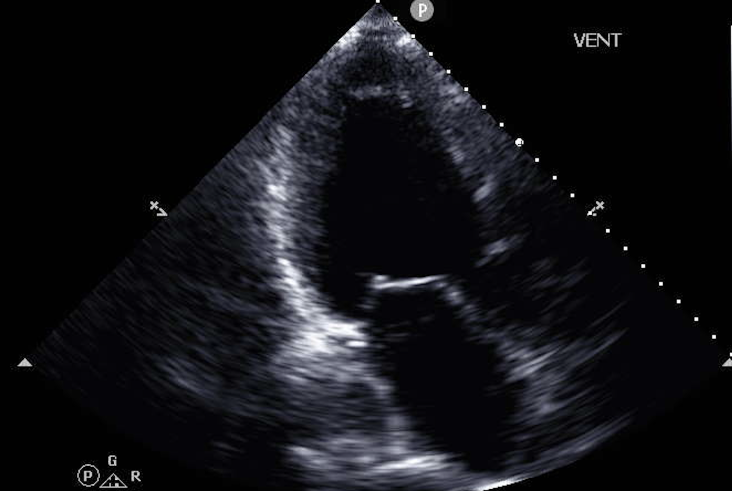 Representative echocardiographic image used to train a machine learning model to identify patients with heart failure.