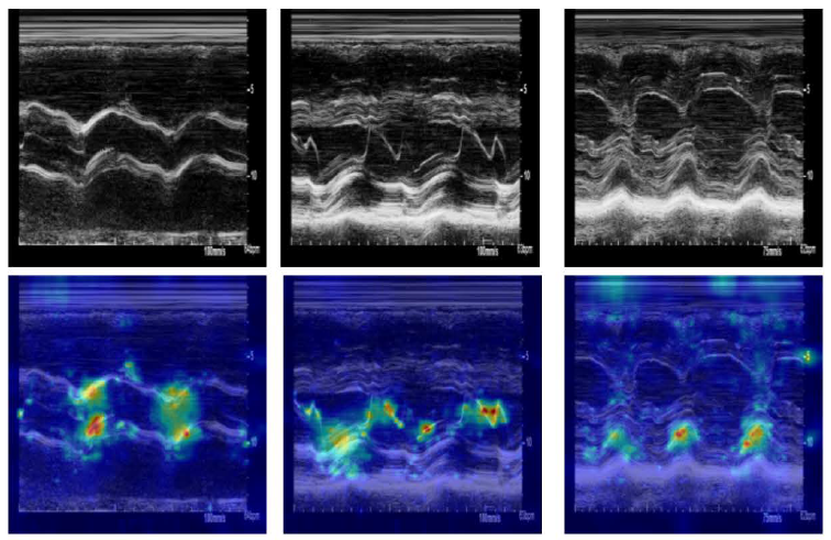 Saliency maps. Only 3 M-Mode samples are shown because that patient only has 3 M-Mode images in our dataset.