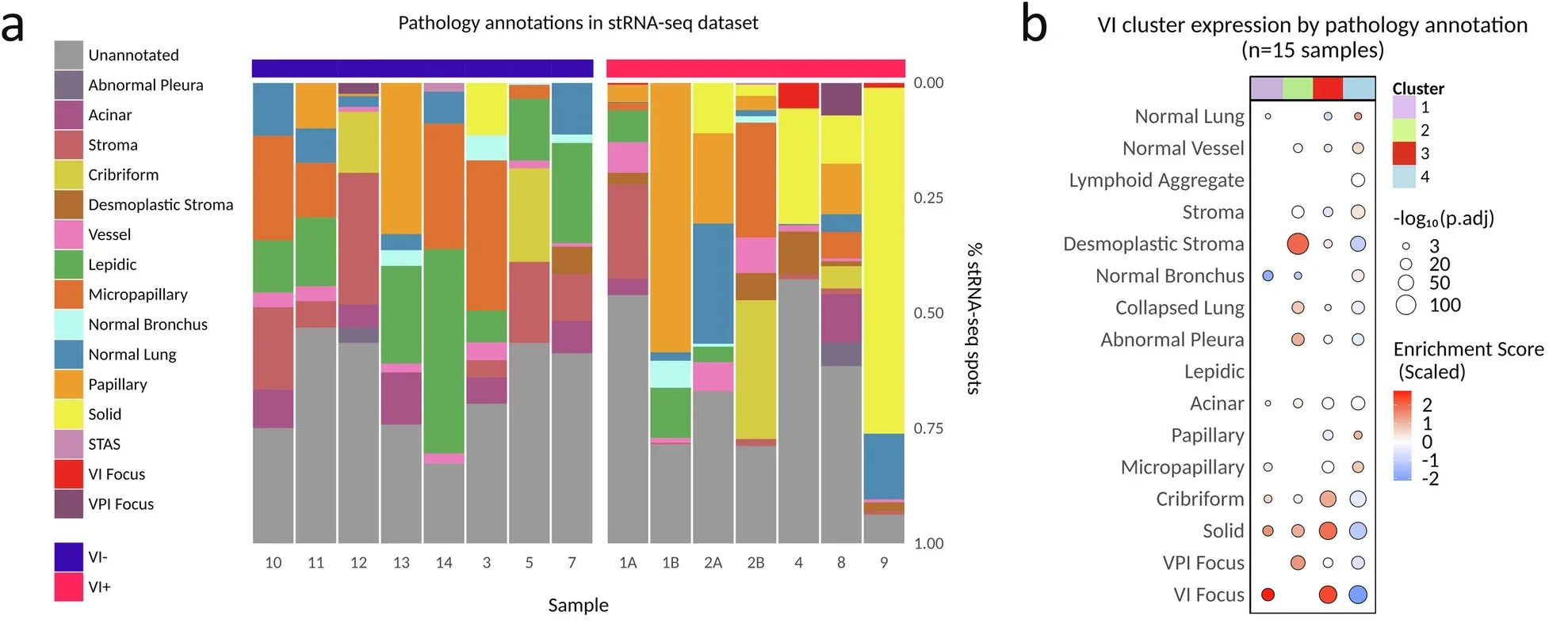 Spatial transcriptomics of early-stage LUAD reveals an association of VI gene clusters with specific LUAD histopathology features.