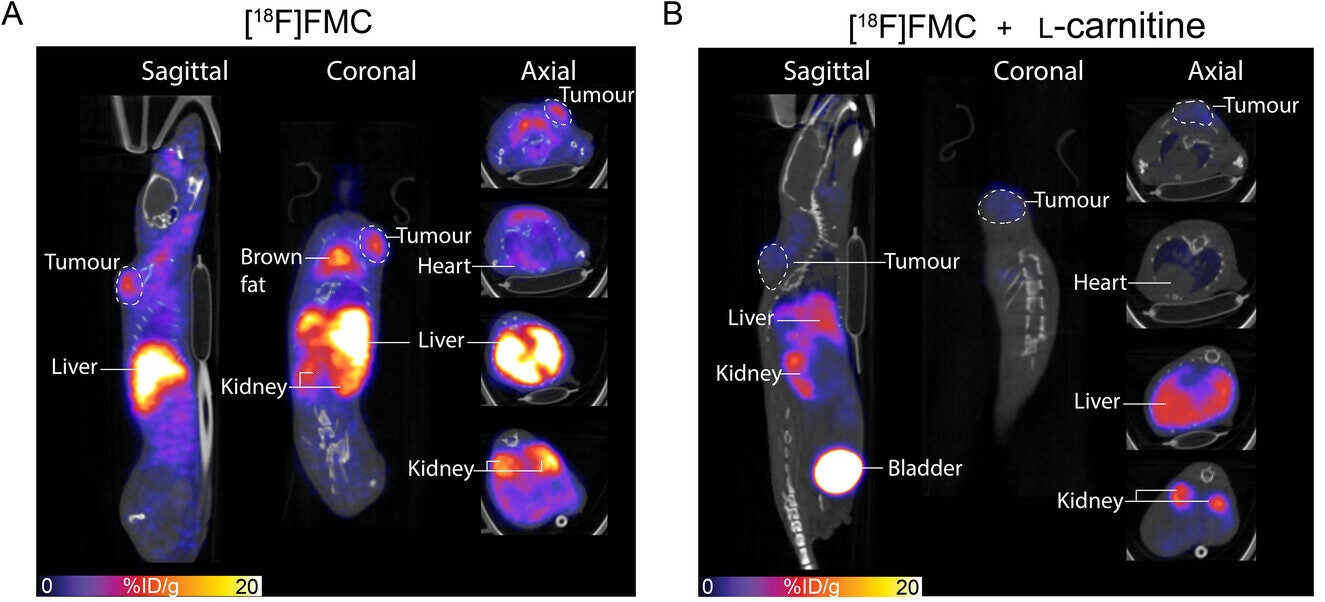 Imaging aberrant carnitine utilisation in NSCLC with [18F]FMC PET.