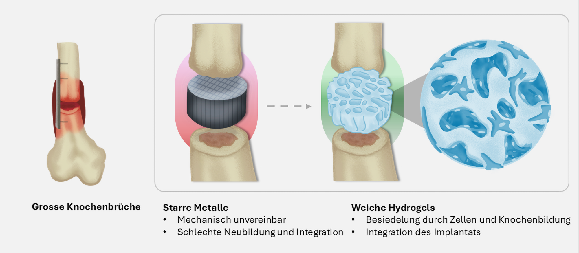 Today, rigid, hard implants are used to connect bones (left). In the future, soft implants made of a hydrogel could be used.