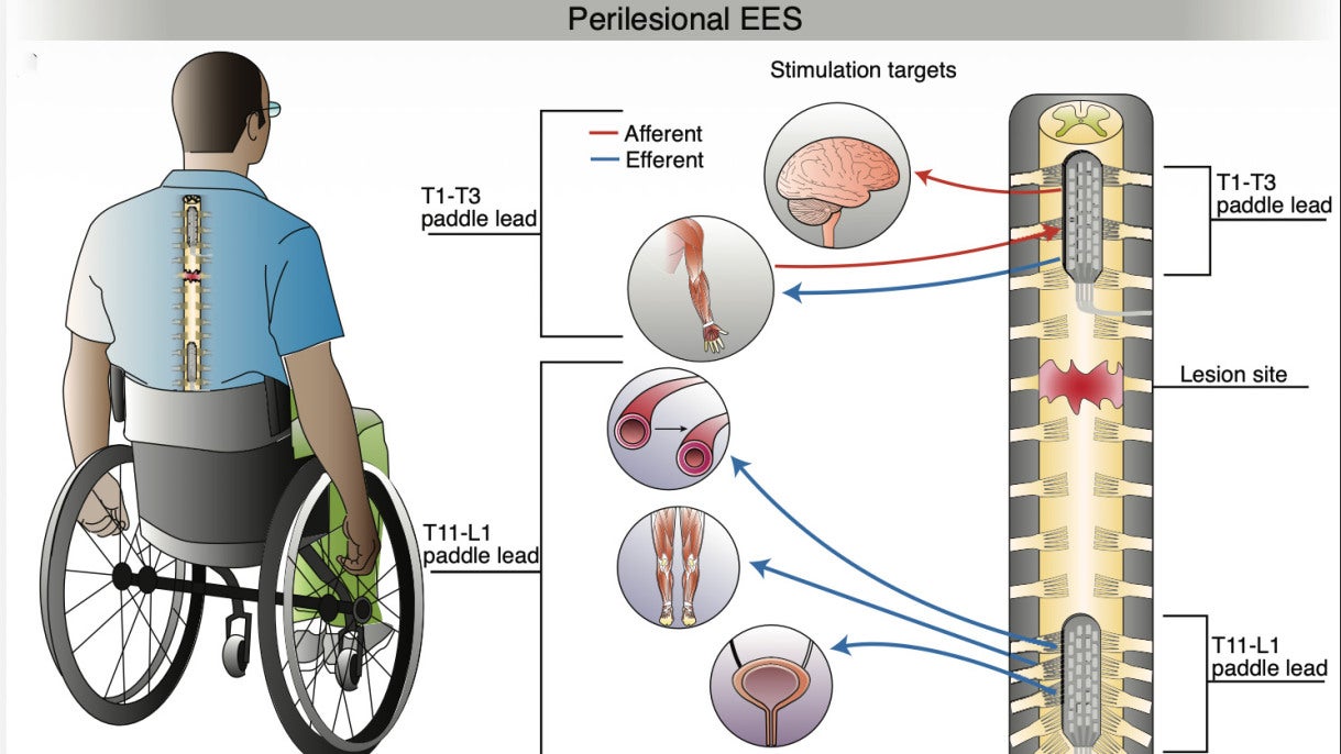 Perilesional EES framework to restore sensorimotor function in individuals with paraplegia.