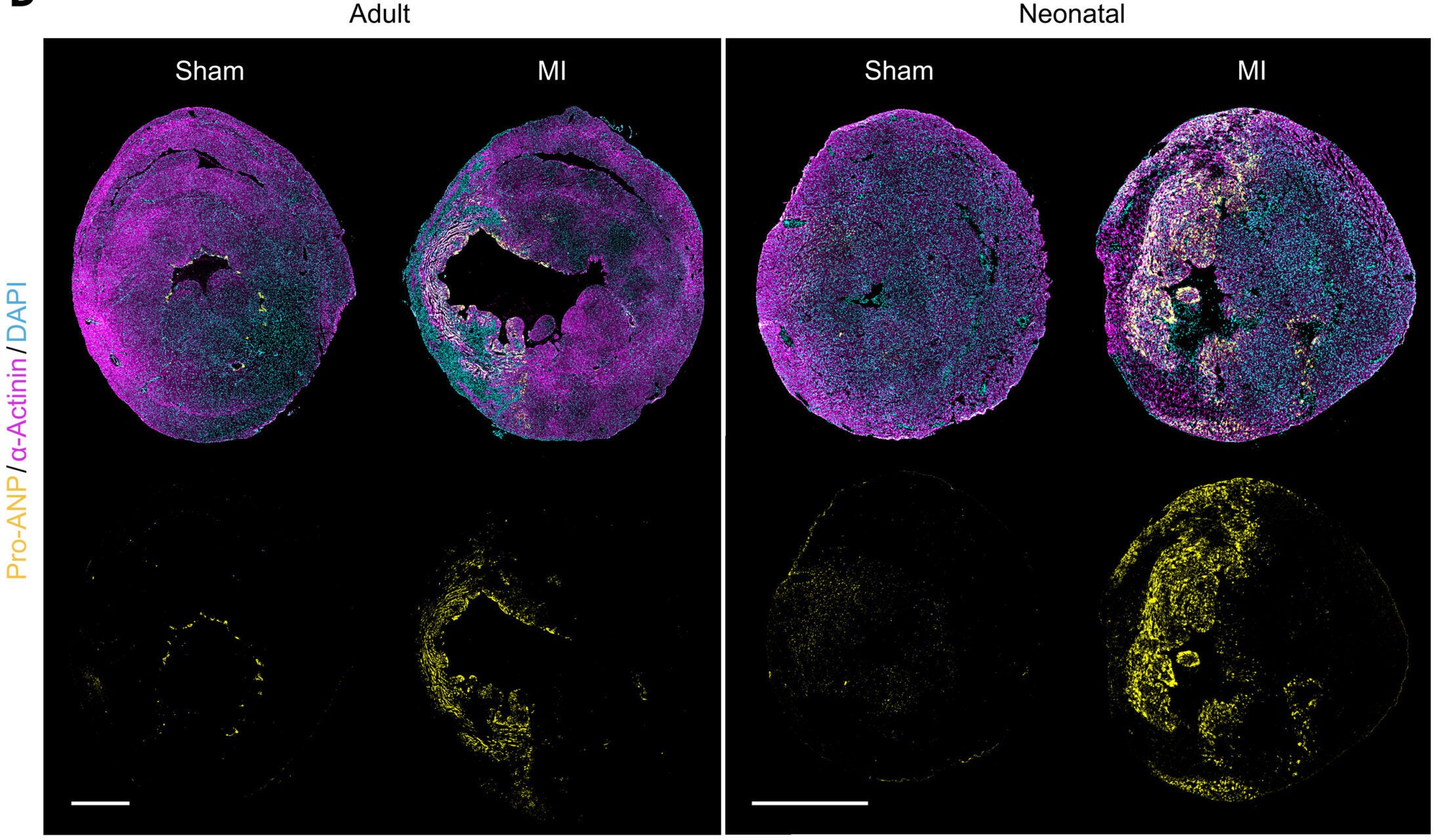 Immunofluorescence staining of pro-ANP (yellow) in hearts from sham-operated and MI mice (α-actinin, magenta, CMs) on day 3 after MI. Nuclei were counterstained with 4′,6-diamidino-2-phenylindole (DAPI) (cyan).