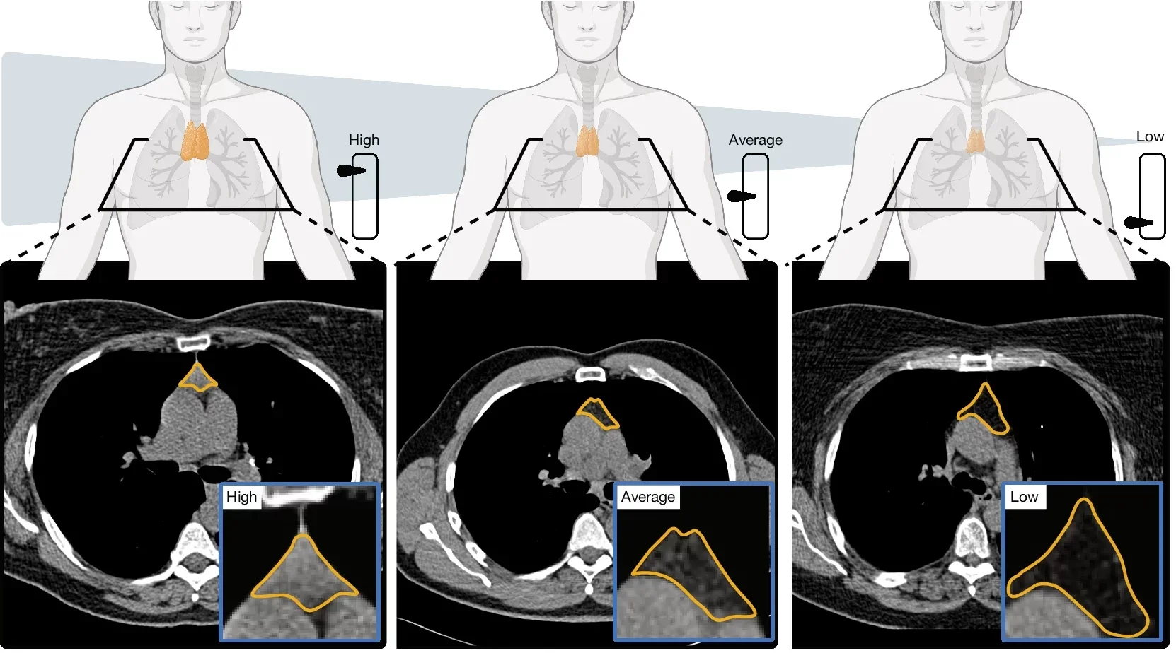 Illustration of thymic health, that is, an imaging-based proxy of thymic functionality and three representative examples of individuals with high, average or low thymic health. The thymus bed is outlined in orange.