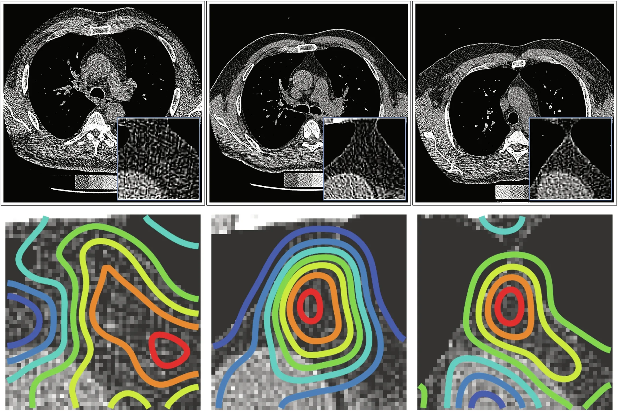 Representative CT scans from the FHS cohort overlaid with the generated occlusion-driven saliency maps using the most important feature, highlighting the regions of the thymus that the model focuses on when making its predictions. The saliency maps are displayed on the central slice of the thymus, and the jet color scale is used to indicate contribution intensity.