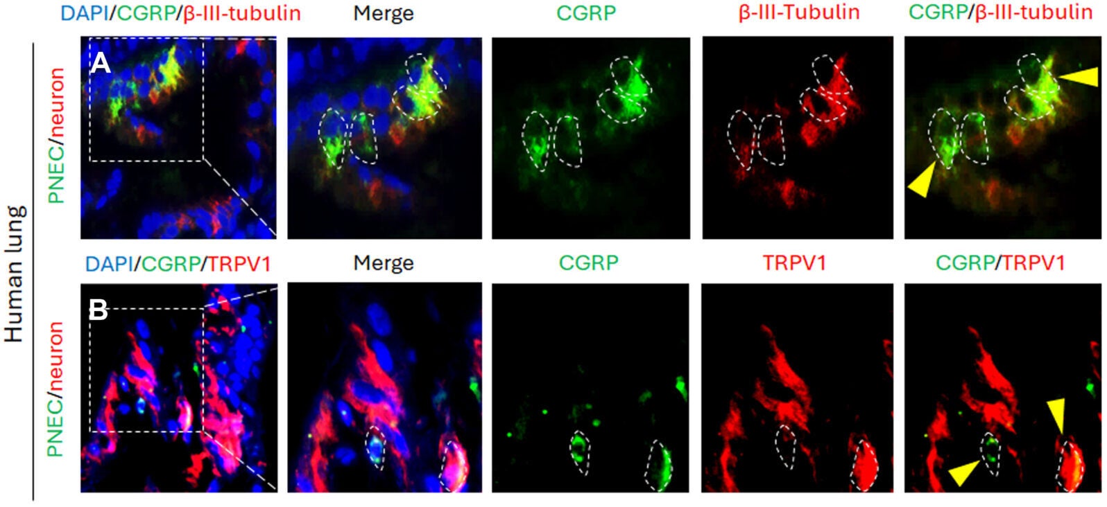 (A and B) Representative immunofluorescence staining images showing expression of (A) β-III-tubulin (pan-neuronal marker) and CGRP (PNEC-associated marker), (B) TRPV1 (sensory neuron–associated marker) and CGRP, in the lung tissue sample of a healthy donor.