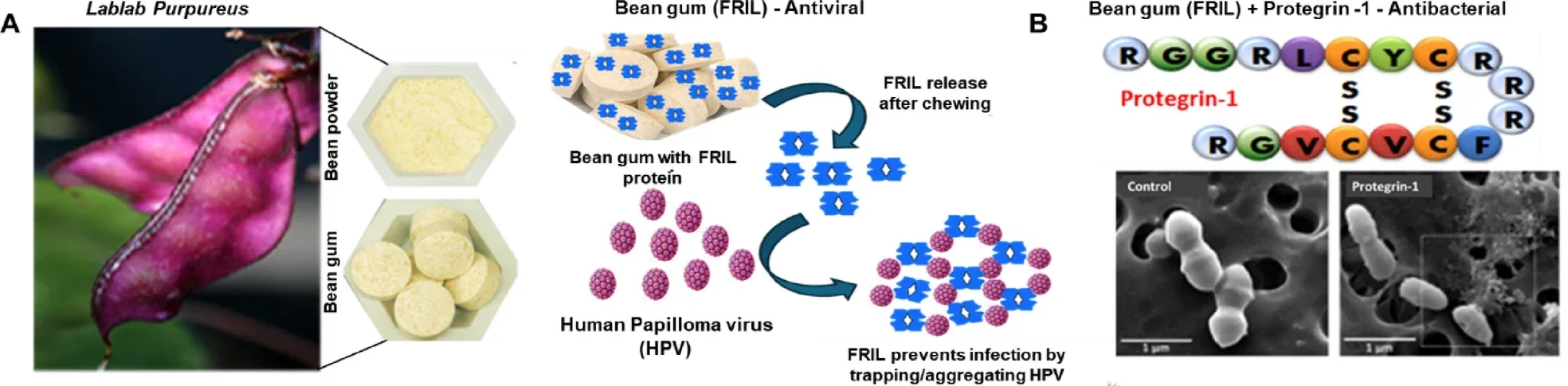 Mechanisms of antiviral bean-gum/antibacterial protegrin-1 and HPV, Pg and Fn in Oral Squamous Cells Carcinoma.