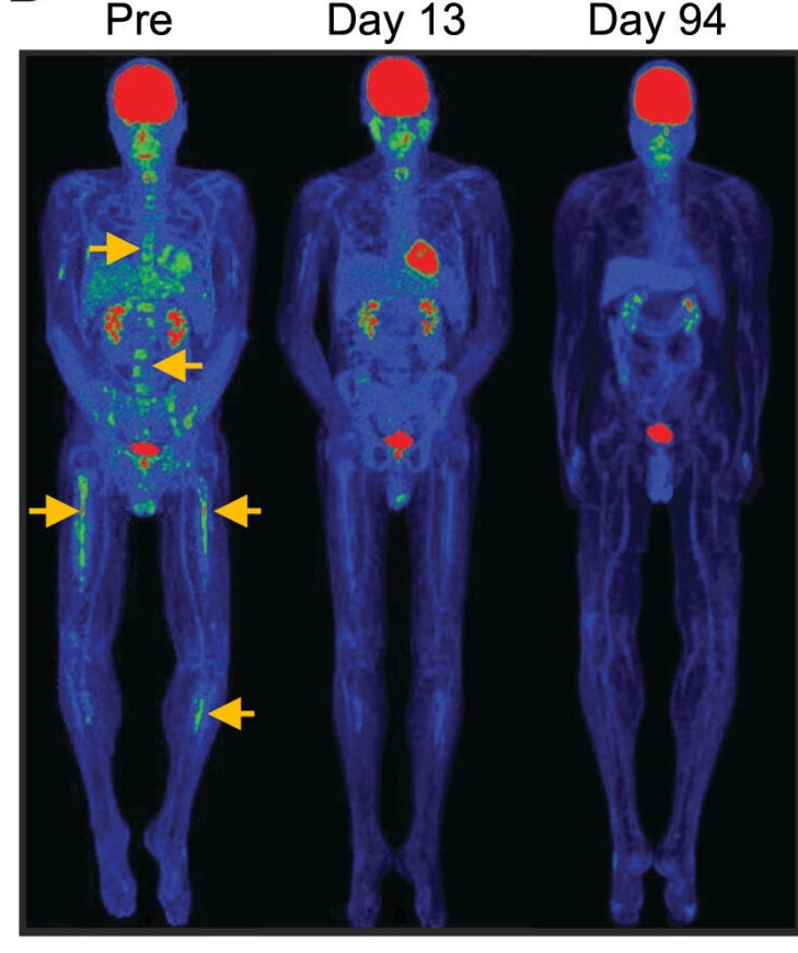PET/CT images showing resolution of B-cell ALL bone lesions (yellow arrows) following the infusion of CAR TSCM cells.