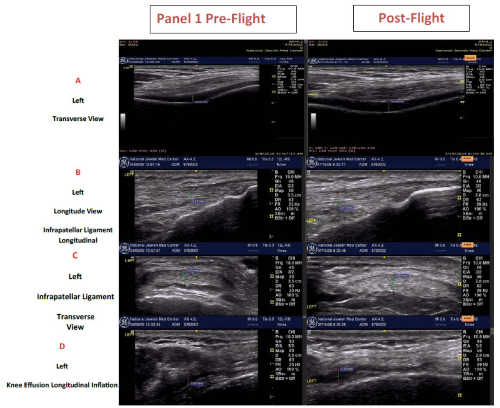 Ultrasound images from one Crew member. Row A images are of the left femoral cartilage transverse view. Row B images are the left Infrapatellar ligament (longitudinal view). Row C is the transverse view of the left infrapatellar ligament. Row D are longitundinal views of the left infrapatellar recess demonstrating a small knee effusion during inlation of the external pneumatic compression device.