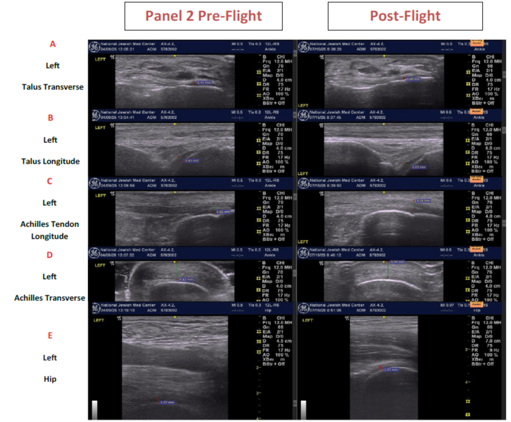 Ultrasound images from one Crew member. Row A are transverse views of the left ankle demonstrating the talus cartilage. Row B are the longitudinal views of the left talus cartilage. Row C are the longitudinal views of the left achilles tendon. Row D are the transverse views of the left achilles tendon. Row E are oblique images of the left hip.