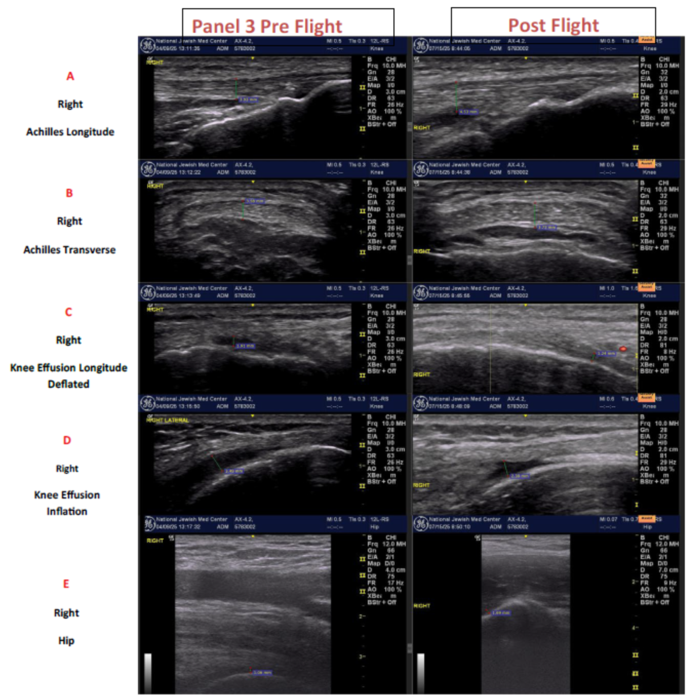 Ultrasound images from the identical astronaut as in panels 1 and 2. Row A are longitudinal views of the right Achilles tendon. Row B are transverse views of the right Achilles tendon. Row C are longitudinal views of the right infrapatellar recess demonstrating a small knee effusion with the external pneumatic compression device deflated. Row D displays the same region as in Row C but with the device inflated which demonstrates a larger knee effusion. Row E displays oblique views of the right hip.