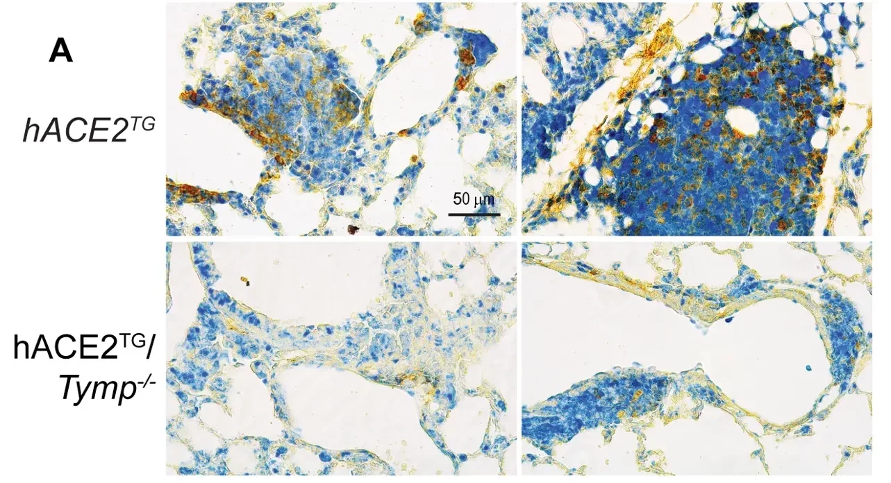 TYMP amplifies STAT3 signaling and drives a profibrotic, pro-tumor microenvironment.