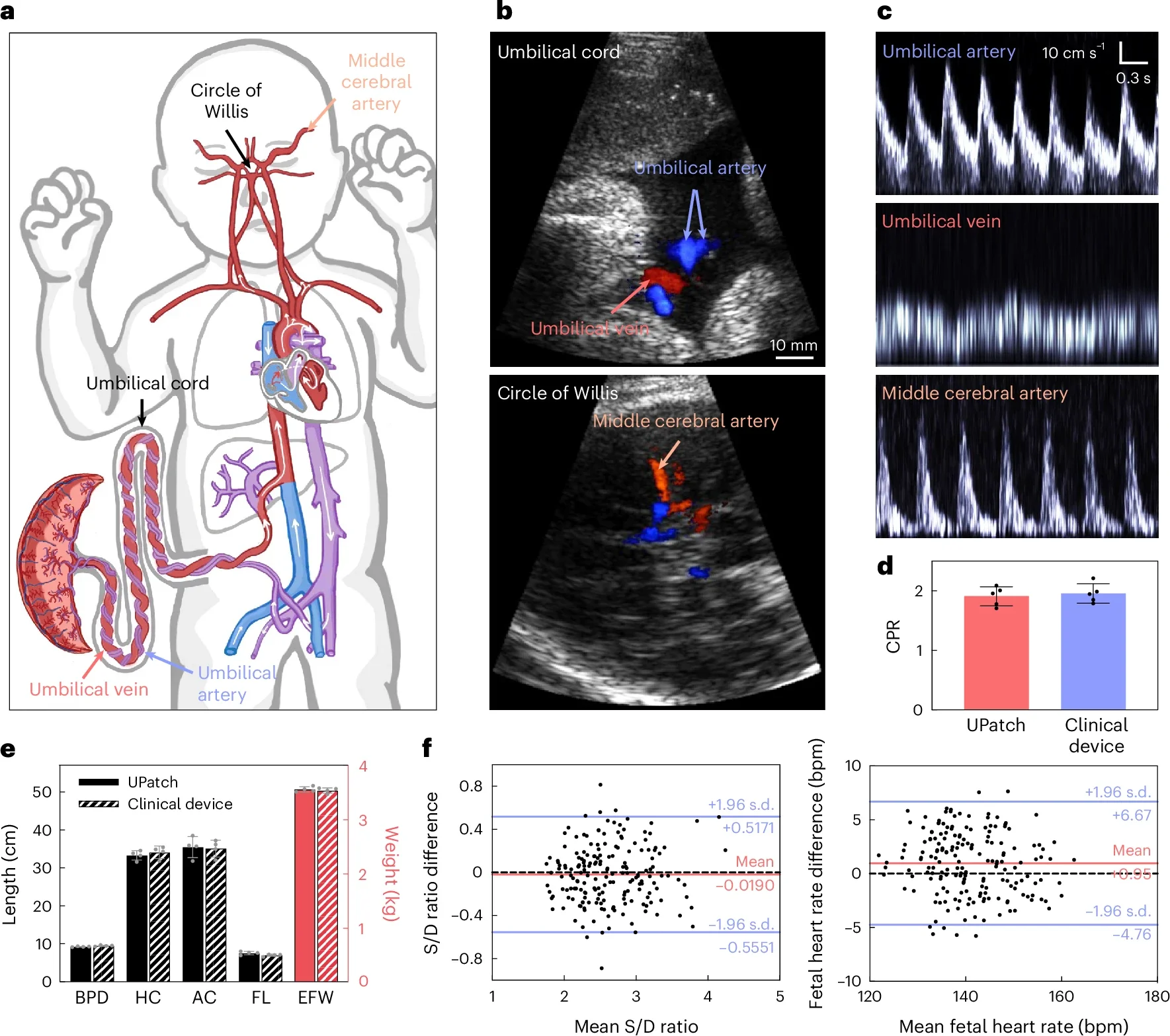 Measurements and validations of the UPatch for fetal monitoring.