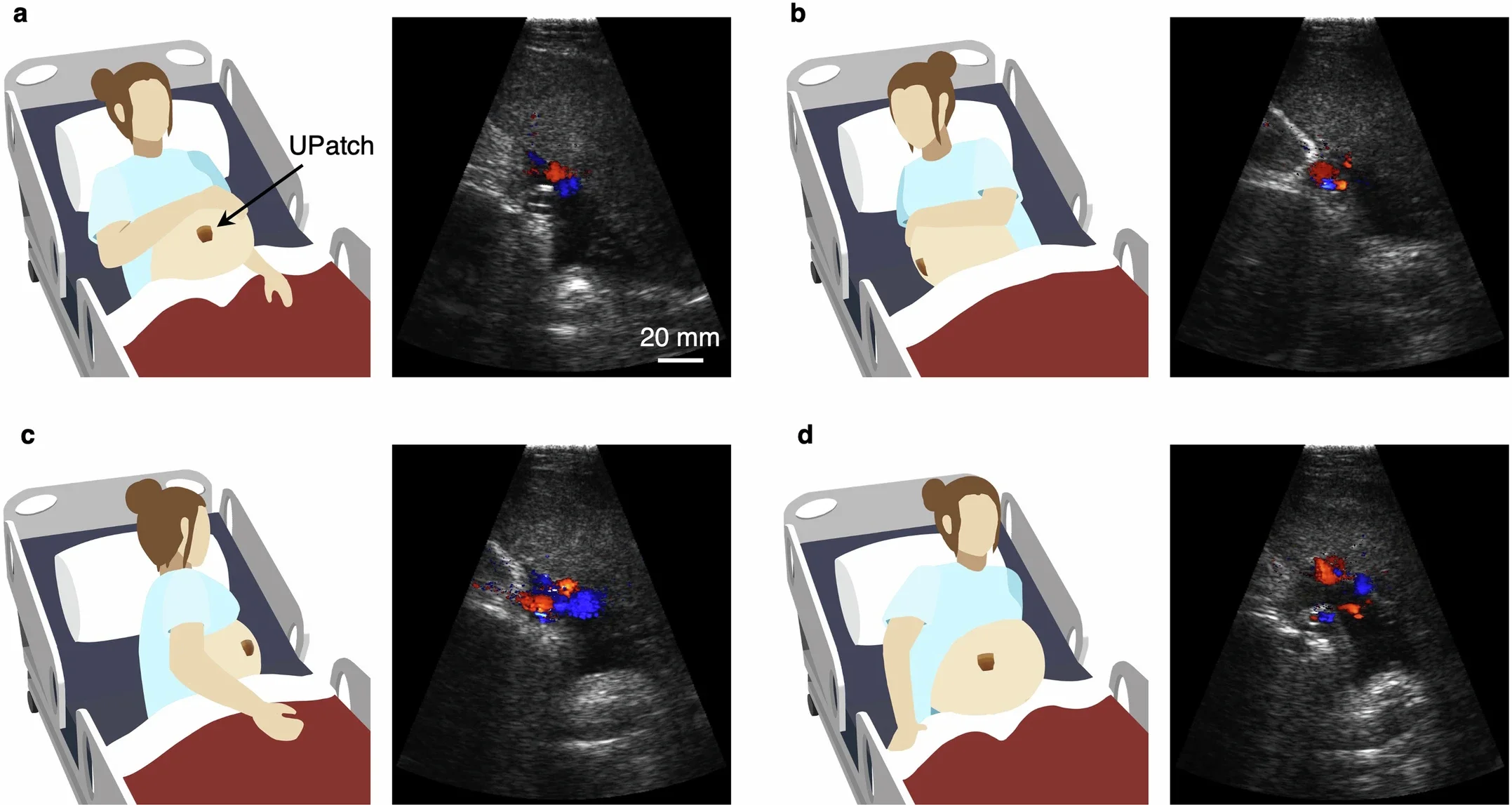 Duplex imaging of the UPatch across various maternal positions.