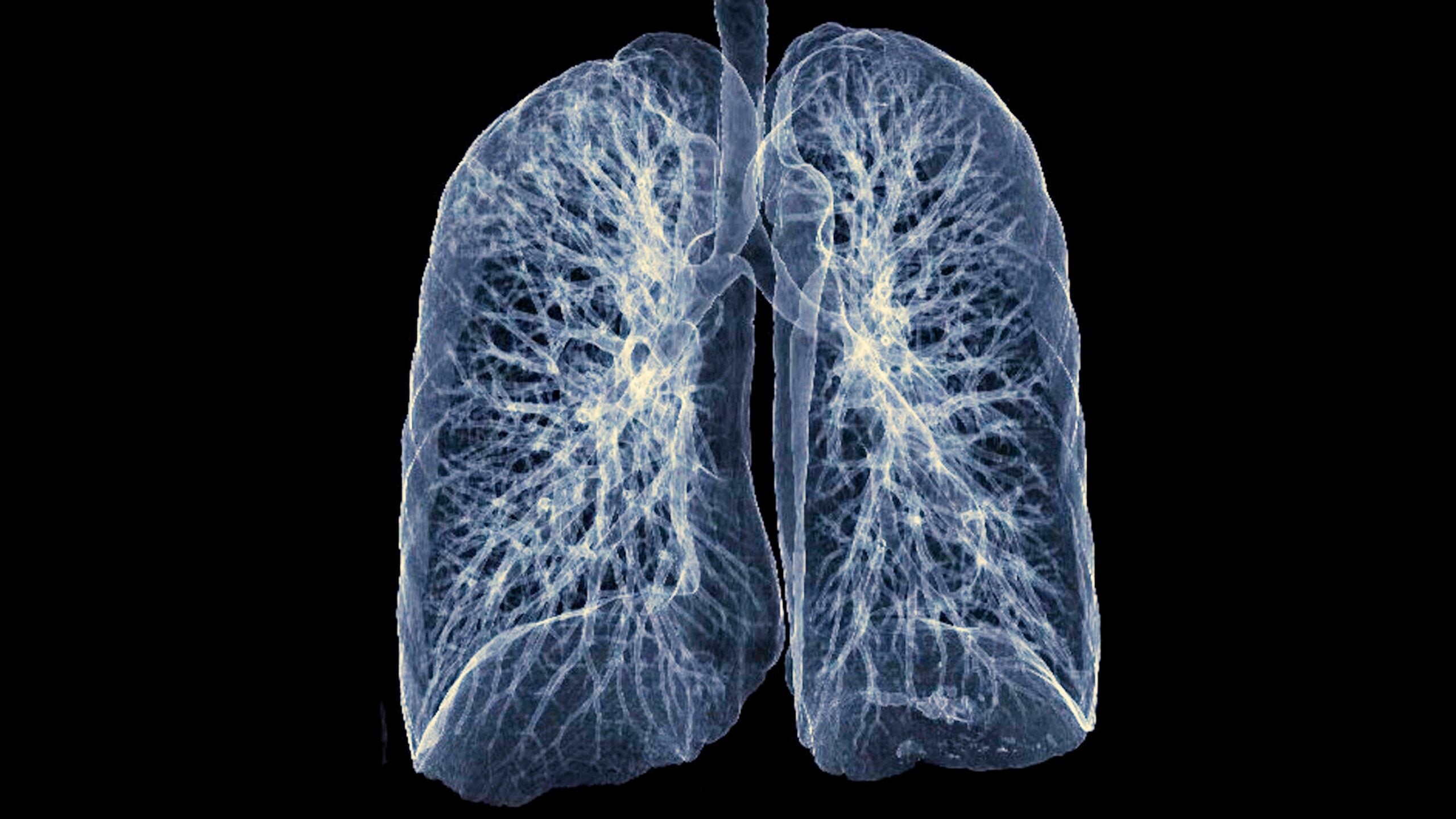 A new study found that blocking the BCL-2 protein cleared harmful lung cells and reversed fibrosis in preclinical models.