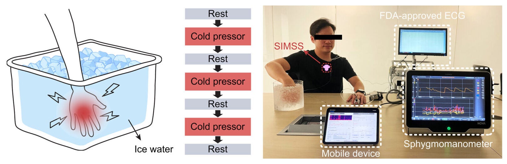 Wireless, wearable monitoring of physiological parameters for detection of physical stress during cold pressor tests.