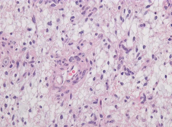 Using routinely prepared and stained tissue sections, Hetairos can predict the molecular subgroup of a CNS tumor