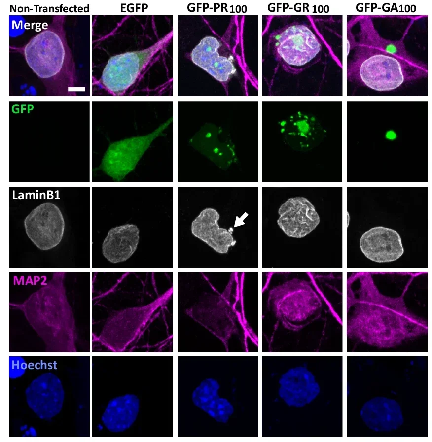 Suppressing LaminB1 phosphorylation by p38 MAPK rescues karyoptosis triggered by C9ORF72 DPRs in in vitro and in vivo ALS/FTD models.
