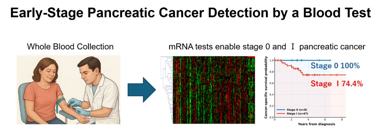 A simple blood test may help detect pancreatic cancer at its earliest stages, including Stage 0 disease, when treatment offers the best chance of survival.
