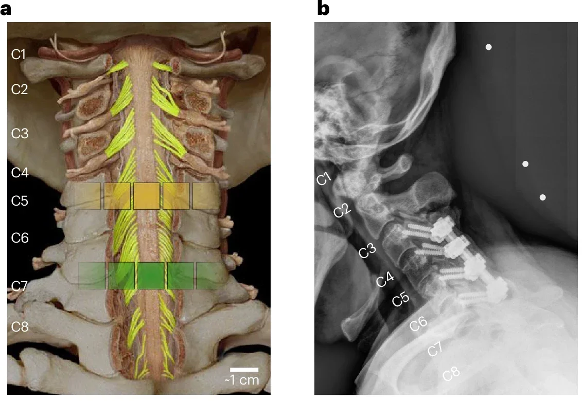 Schematic showing the locations on the cervical spinal cord dynamically targeted by the custom tSCS electrode patch: C5–C6 (yellow electrodes) and C7–C8 (green electrodes) spinal root.
