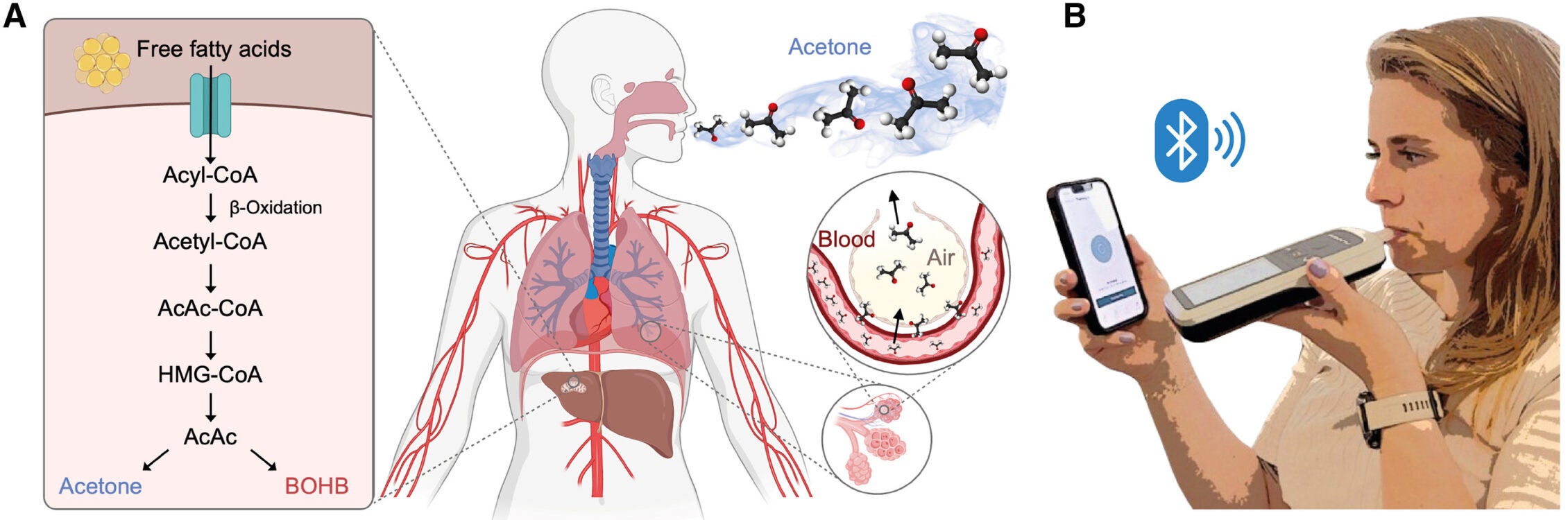 Smartphone-guided breath acetone monitoring enables assessment of metabolic state at home