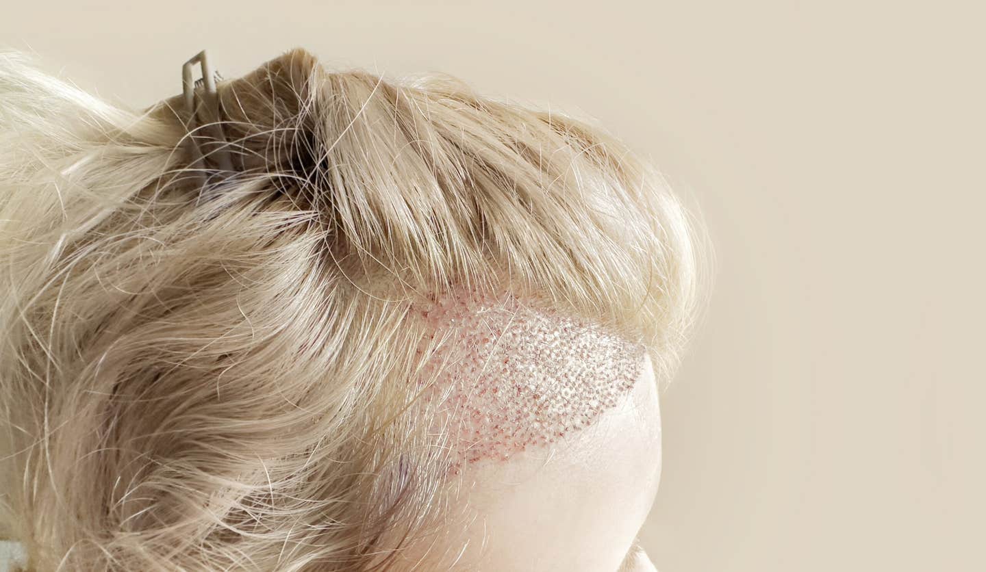 Researchers reveal that hair follicle patterns emerge from simple cell interactions, offering new insight into development.