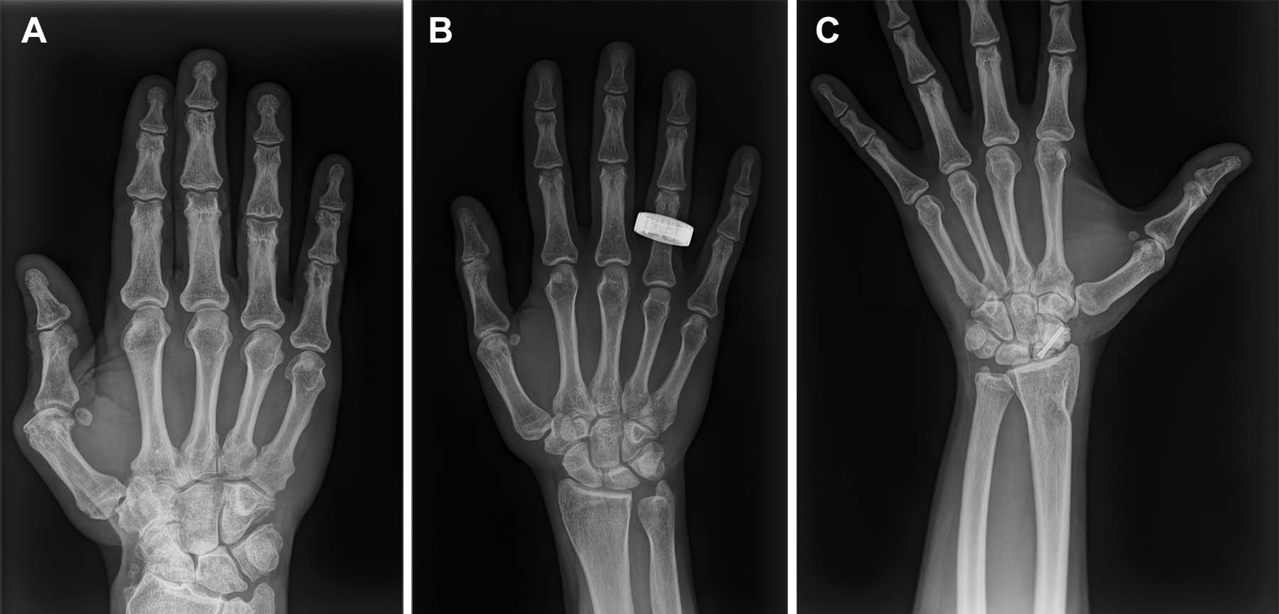 Representative preflight, in-flight, and postflight hand radiographs.