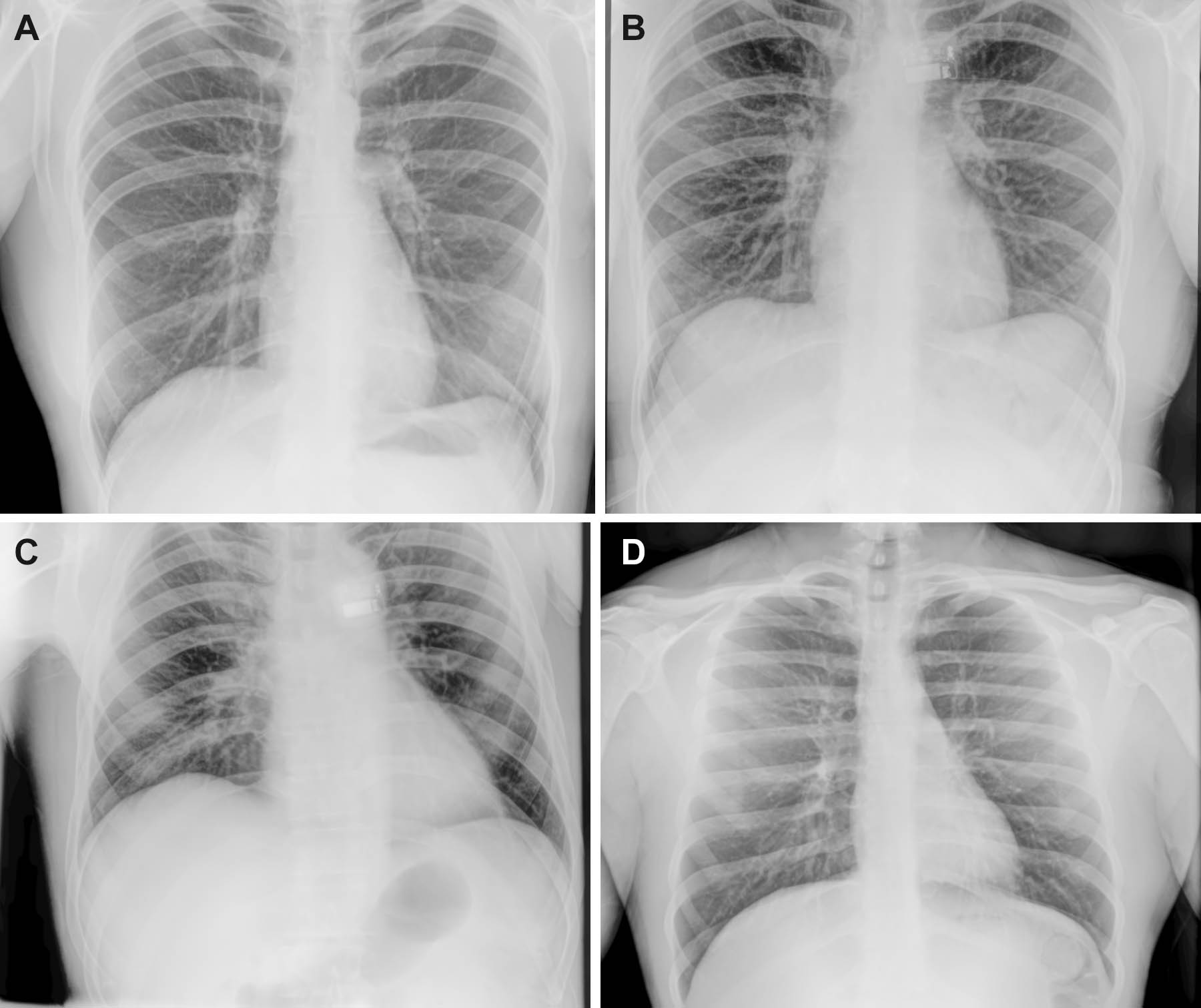 Representative preflight, in-flight, and postflight chest radiographs.